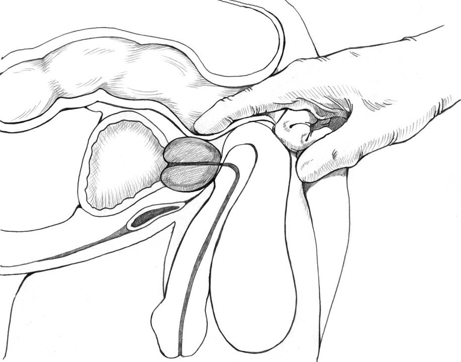 Masaža prostate uključena je u kompleks metoda liječenja prostatitisa